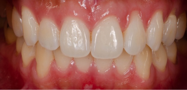gum recession